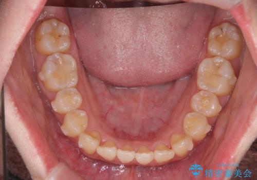 前歯のねじれ 矯正治療による歯並び改善の治療前