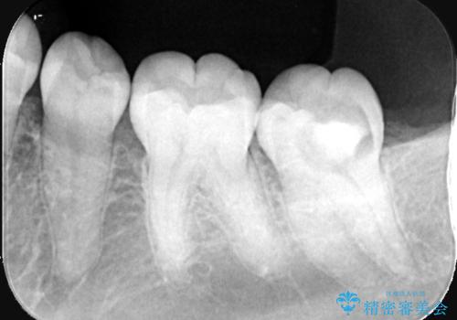 奥歯の激しい痛みを解消し、歯を長持ちさせる精密治療の治療前