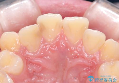 【セラミッククラウン】【精密根管治療】前歯が痛いの治療前