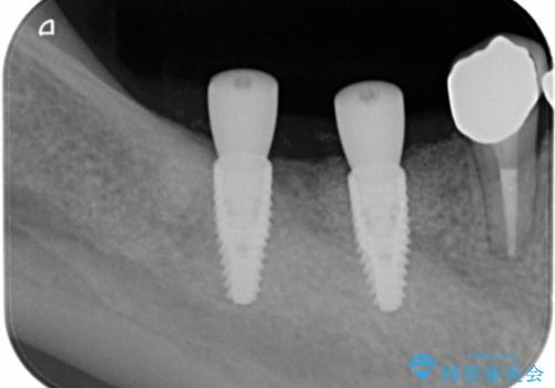 遊離歯肉移植術を伴うインプラント治療の治療中