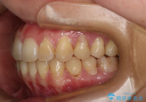 下の前歯のガタつきを治したい インビザライン・ライトパッケージの治療後