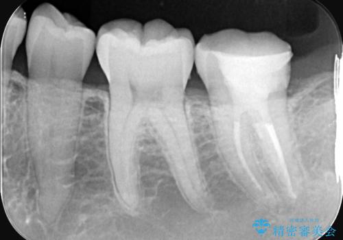 奥歯の激しい痛みを解消し、歯を長持ちさせる精密治療の治療後