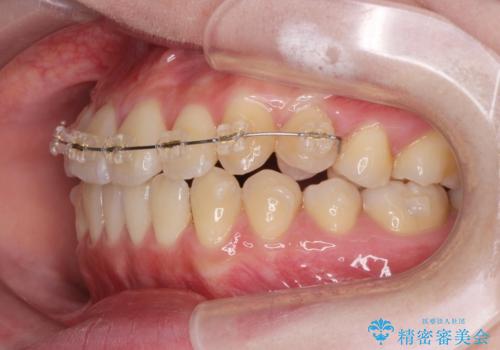 前歯のねじれ 矯正治療による歯並び改善の治療前