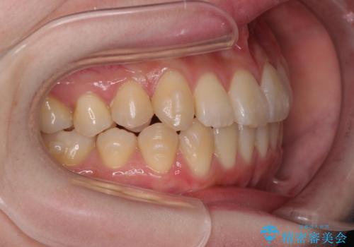 前歯のねじれ 矯正治療による歯並び改善の治療中