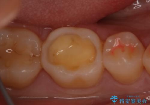 奥歯の虫歯を治療したい セラミックインレーの治療中