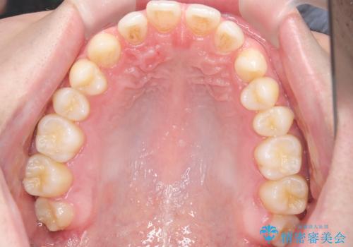 【ワイヤー矯正】歯列の隙間を閉じたいの治療前