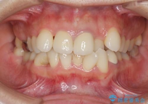 著しいがたつきによる清掃困難 歯牙抜去とセラミック治療の治療後