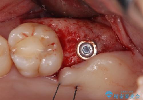 噛むと歯が疼く 歯牙破折からのインプラント治療の治療中