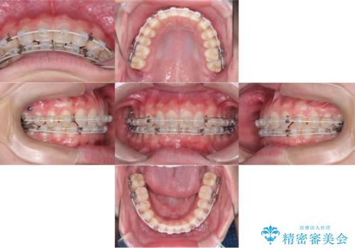 【ワイヤー矯正】歯列の隙間を閉じたいの治療中