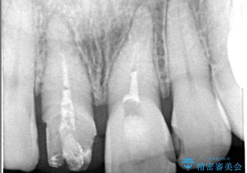 前歯の色が気になる!|他院で抜歯と言われた|歯を残したい|精密根管治療とオールセラミッククラウンで治療の治療前