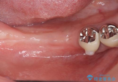 遊離歯肉移植術を伴うインプラント治療の治療中