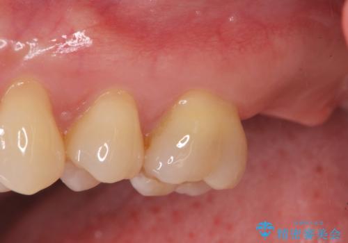 噛むと歯が疼く 歯牙破折からのインプラント治療の治療前
