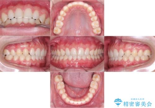 【ワイヤー矯正】歯列の隙間を閉じたいの症例 治療後