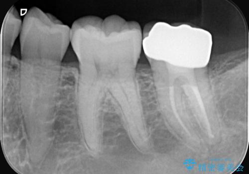 奥歯の激しい痛みを解消し、歯を長持ちさせる精密治療の治療後