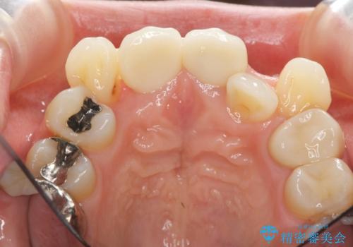 著しいがたつきによる清掃困難 歯牙抜去とセラミック治療の治療後