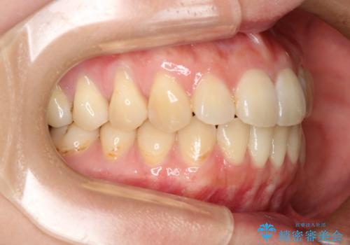 下の前歯のガタつきを治したい インビザライン・ライトパッケージの治療前