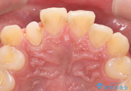 【セラミッククラウン】【精密根管治療】前歯が痛いの治療中