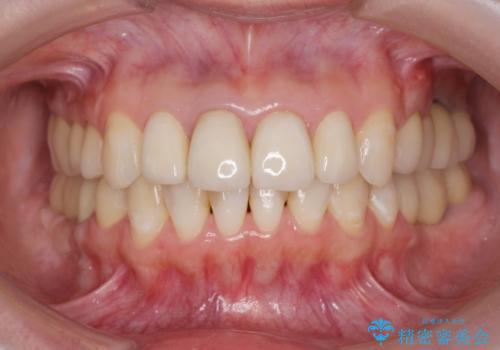 虫歯だらけの前歯をセラミック治療の症例 治療後
