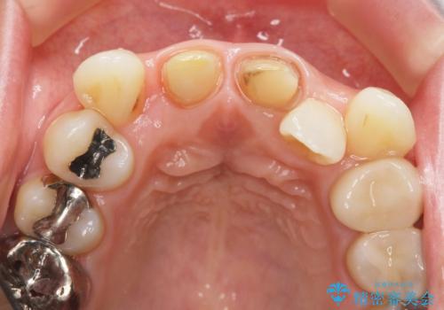 著しいがたつきによる清掃困難 歯牙抜去とセラミック治療の治療中