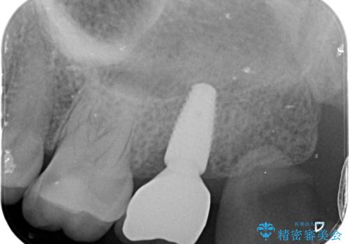 噛むと歯が疼く 歯牙破折からのインプラント治療の治療後