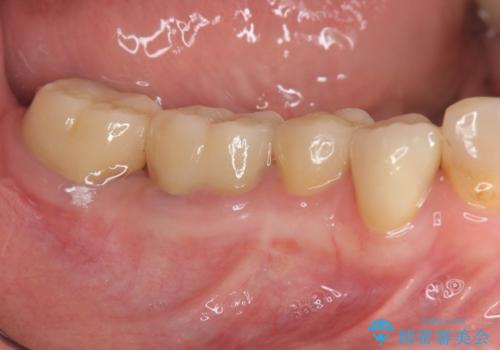 歯周病治療&セラミック治療の症例 治療後