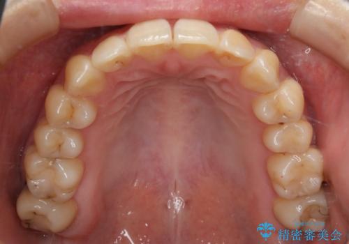 下の前歯のガタつきを治したい インビザライン・ライトパッケージの治療後