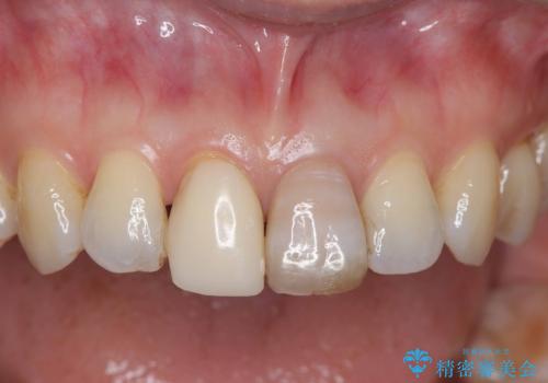 前歯の色が気になる!|他院で抜歯と言われた|歯を残したい|精密根管治療とオールセラミッククラウンで治療の治療前