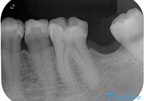 詰め物が外れかけてるのでやり替えたい セラミックインレー修復・フルジルコニアクラウンの治療前