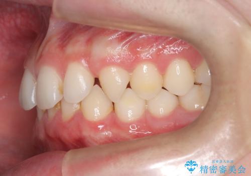 【ワイヤー矯正】歯列の隙間を閉じたいの治療前