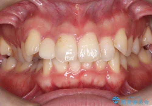 【セラミッククラウン】【精密根管治療】前歯が痛いの症例 治療後