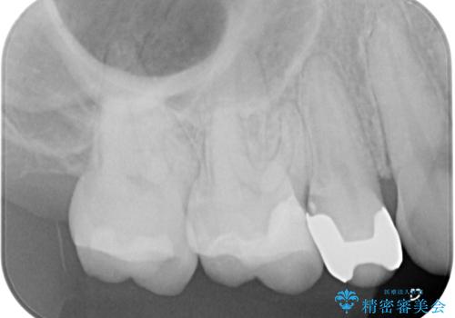 銀歯をやり替えたい セラミックインレー修復の治療後