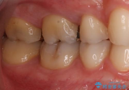 奥歯の再治療をしたい ゴールドインレーの治療後