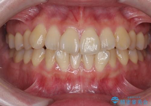 前歯のねじれ 矯正治療による歯並び改善の症例 治療前