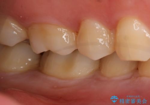 奥歯の虫歯を治療したい セラミックインレーの治療前