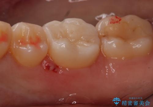 奥歯の虫歯を治療したい セラミックインレーの治療後
