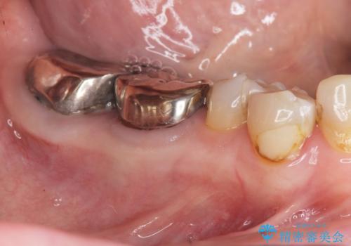 [ 奥歯の歯周病 ] エムドゲインを用いた再生治療の治療前