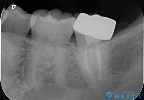 奥歯の激しい痛みを解消し、歯を長持ちさせる精密治療の治療後