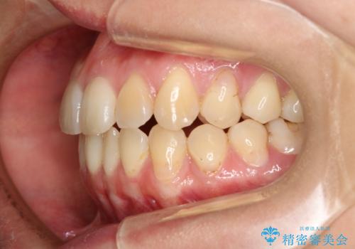 下の前歯のガタつきを治したい インビザライン・ライトパッケージの治療前
