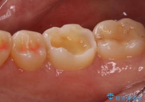 奥歯の虫歯を治療したい セラミックインレーの治療中