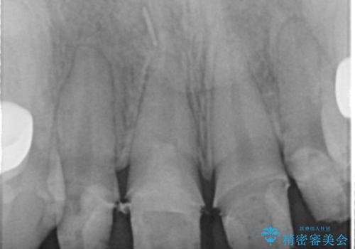 虫歯だらけの前歯をセラミック治療の治療中