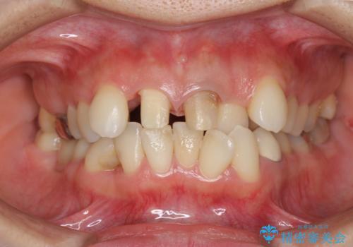 著しいがたつきによる清掃困難 歯牙抜去とセラミック治療の治療中