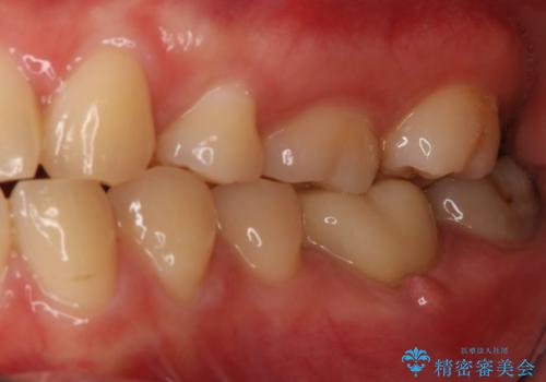 左下奥歯が腫れて痛い フルジルコニアクラウンの治療前