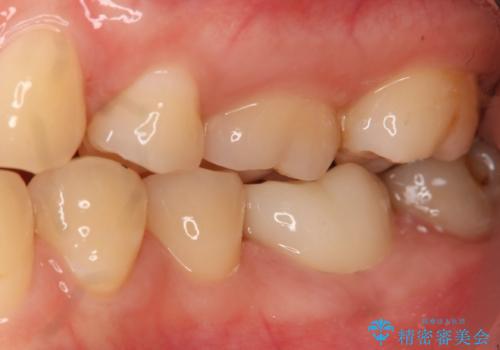 左下奥歯が腫れて痛い フルジルコニアクラウンの治療後