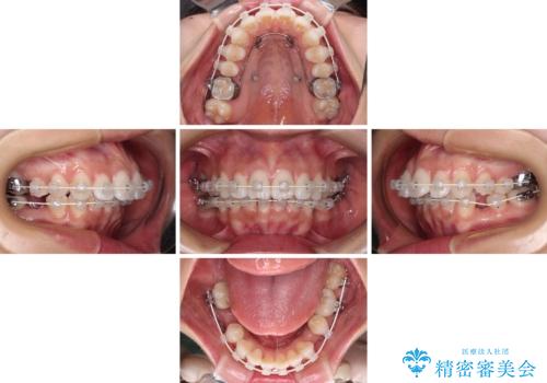 膨らんだ口元を改善する抜歯矯正 インプラント治療も同時に行う総合歯科治療の治療中