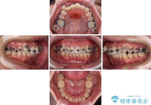 【モニター】八重歯とデコボコを治したい 補助装置を併用したワイヤー矯正の治療中