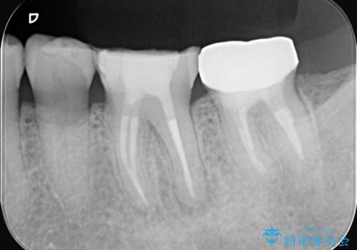奥歯の痛みも、顕微鏡で精密に解消の治療中
