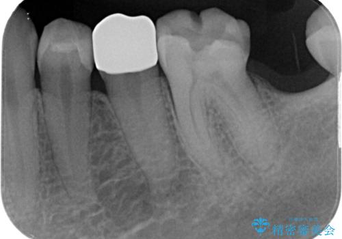詰め物が外れかけてるのでやり替えたい セラミックインレー修復・フルジルコニアクラウンの治療後