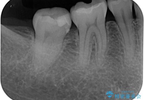 右下に虫歯ができた セラミックインレー修復の治療後