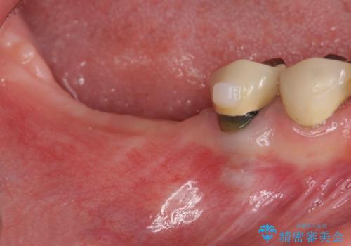 遊離歯肉移植術を伴うインプラント治療の治療中