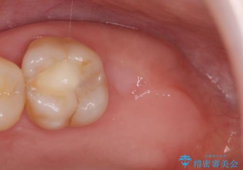 噛むと歯が疼く 歯牙破折からのインプラント治療の治療中